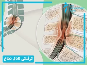 گرفتگی کانال نخاع