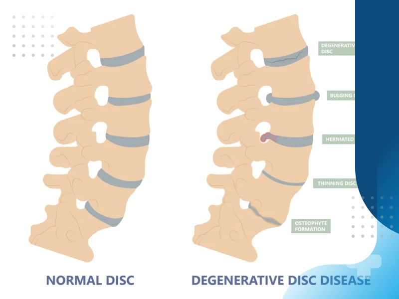 دیسک کمر و تأثیر آن در رابطه زناشویی