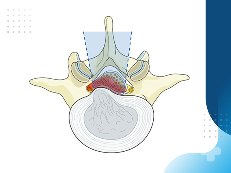تفاوت دیسک کمر حاد و مزمن در رابطه زناشویی