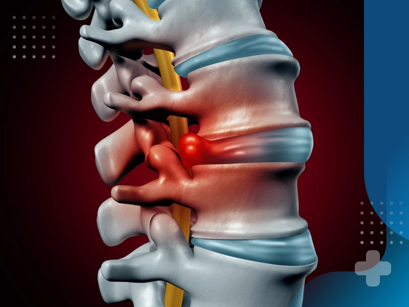 دیسک کمر چیست