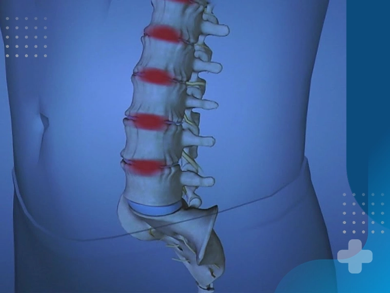علائم رایج بیرون زدگی دیسک کمر