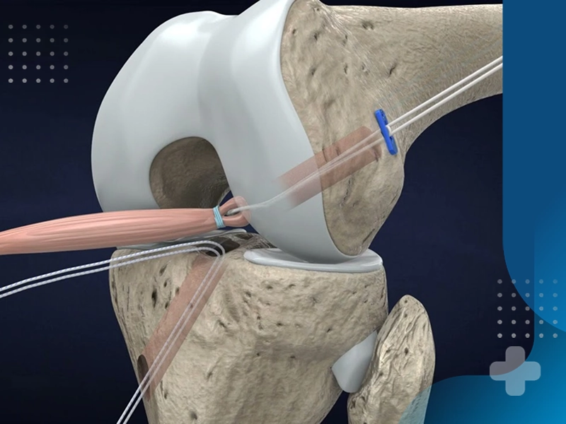 اهداف اصلی در تمرینات بازتوانی پس از آسیب های رباط صلیبی