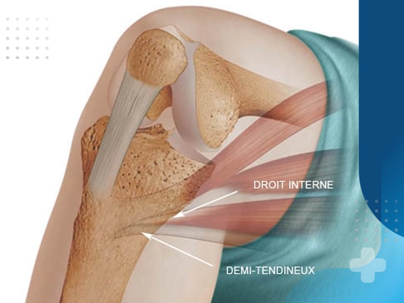 تمرینات بازتوانی پس از آسیب های رباط صلیبی