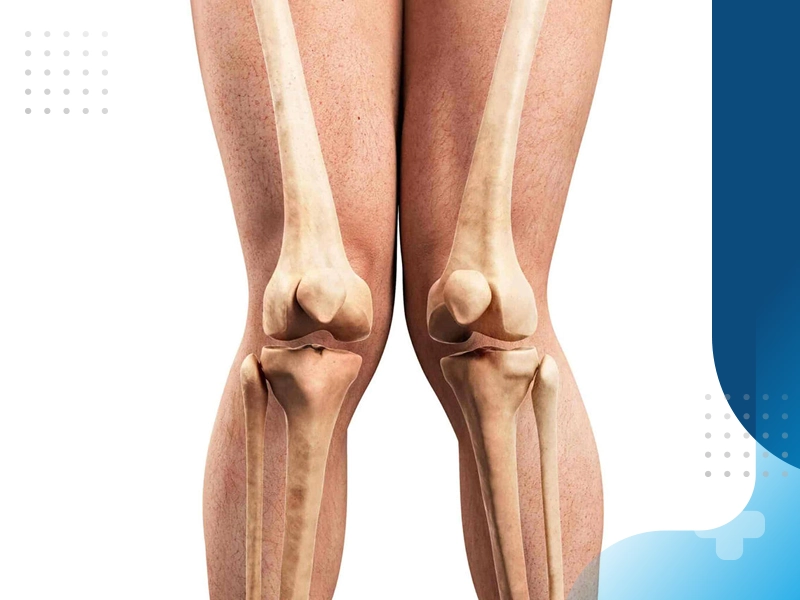 درمان پای پرانتزی با فیزیوتراپی