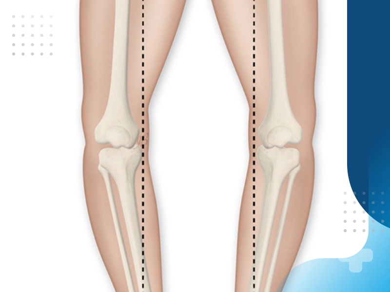 جراحی پای پرانتزی