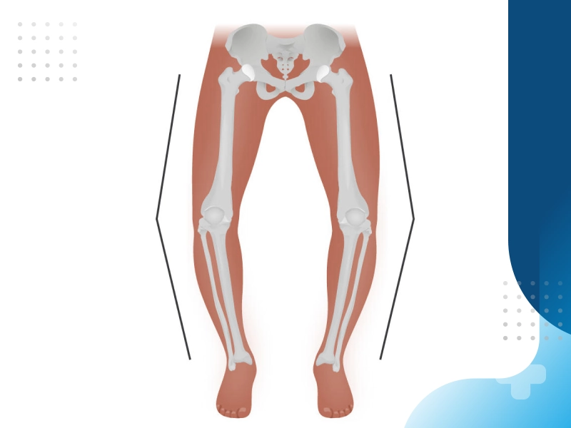 تاثیر تمرینات تقویتی بر اصلاح پای پرانتزی