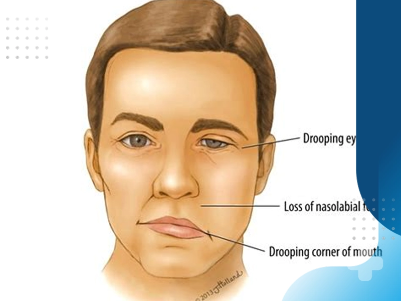 فلج بلز چه عوارضی ایجاد می کند؟