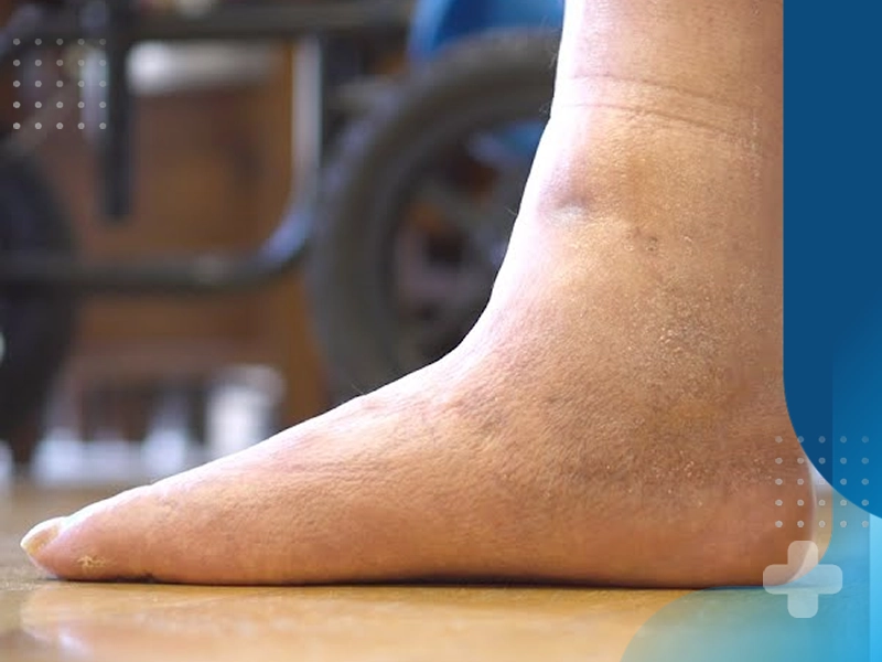 فیزیوتراپی برای صافی کف پا