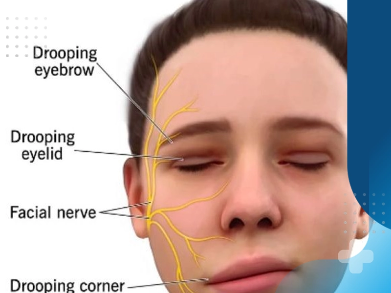 علائم و نشانه های فلج بلز چیست؟