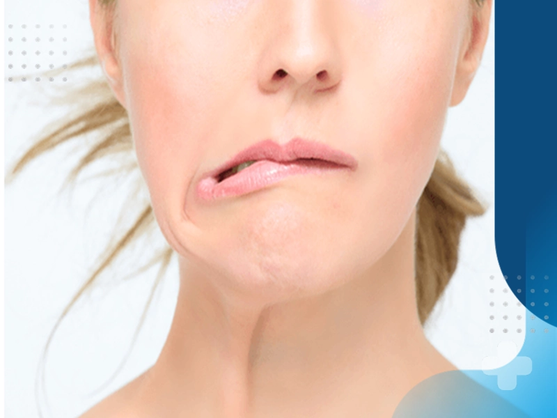 چگونه با فیزیوتراپی فلج بلز را بهبود دهیم؟